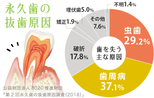 永久歯の抜歯原因　歯周病・虫歯・破折・矯正・埋伏歯など