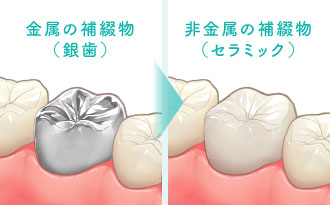 金属の補綴物（銀歯）／非金属の補綴物（セラミック）